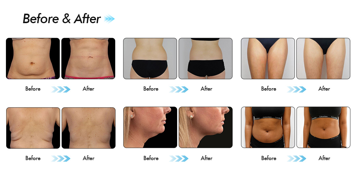 Cryolipolysis bantningsmaskin