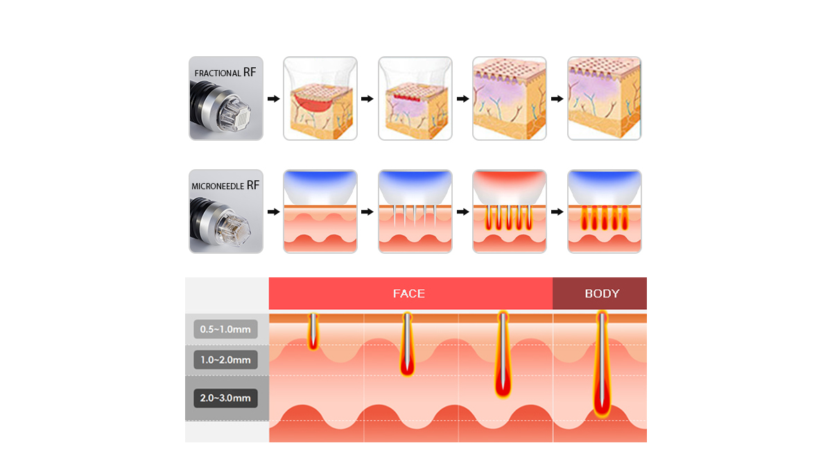 Microneedle Fractional RF-maskin